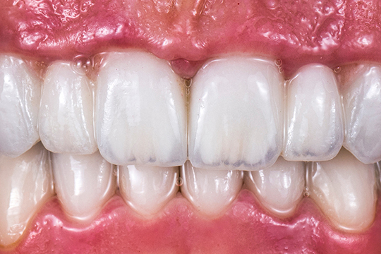 症例１アフター