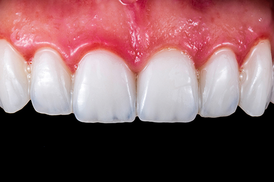 症例２アフター