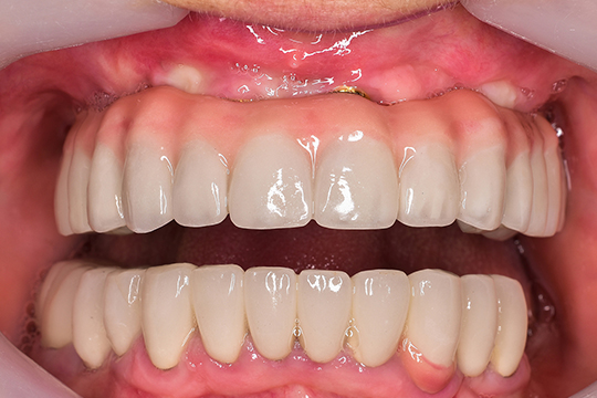 症例３アフター