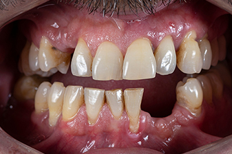 症例５ビフォー