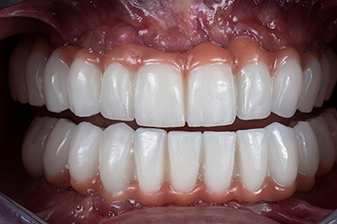 症例５アフター