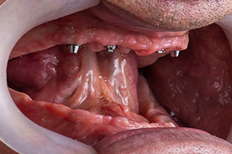 症例６ビフォー