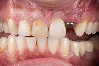 症例９ビフォー