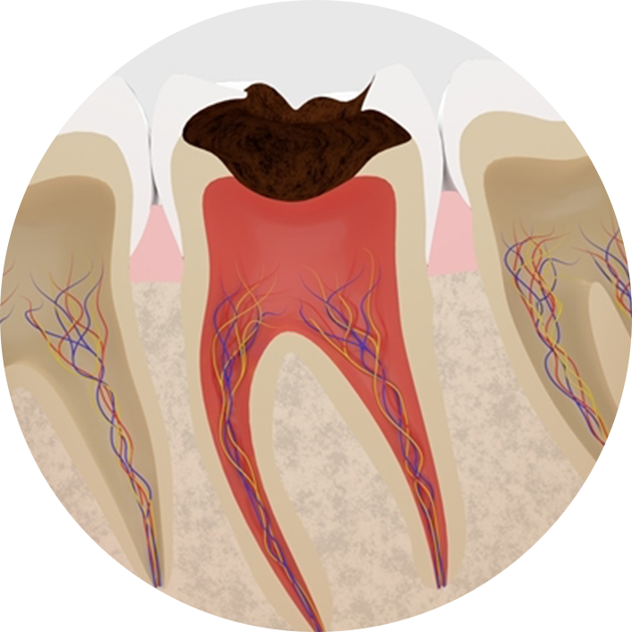 虫歯で歯がボロボロになって