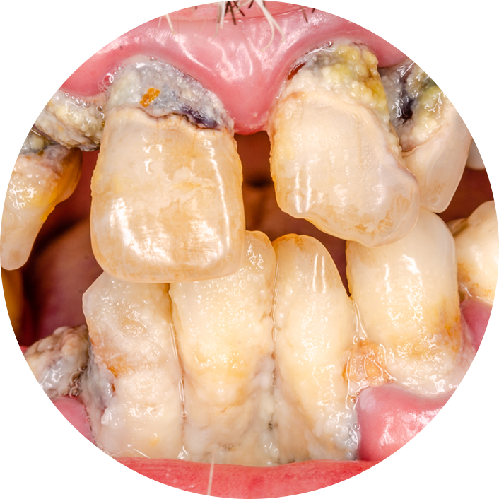 歯周病で腫れ・出血・グラつきが出る