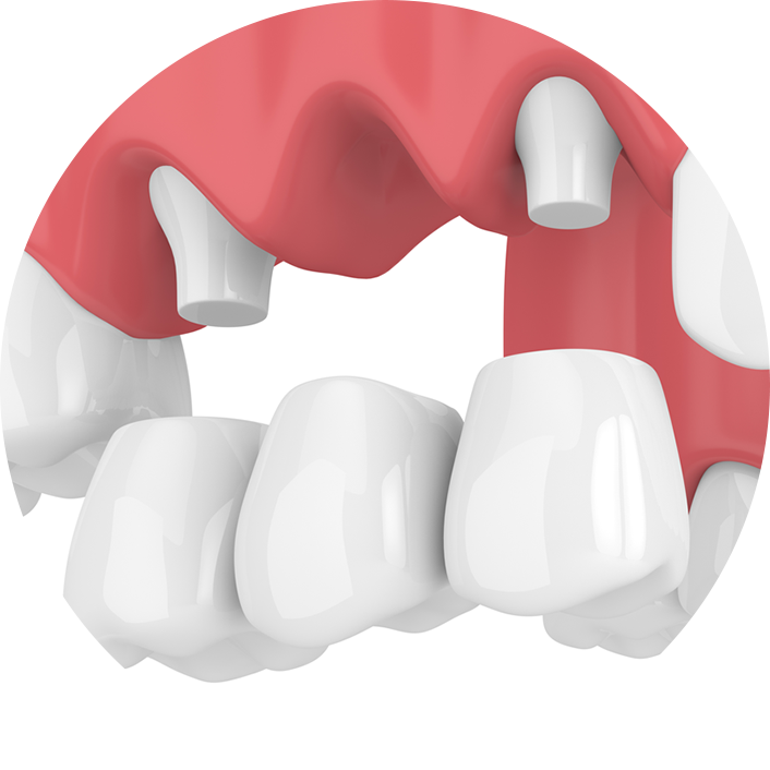 ブリッジ治療を繰り返している