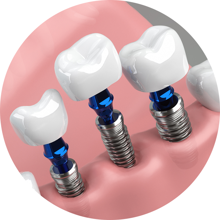 インプラントで歯の治療を考えている